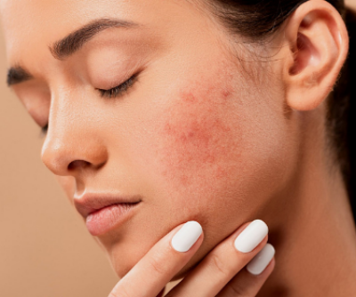 Everything you need to know about acne