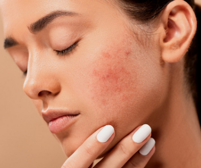 Tot ce trebuie sa stii despre acnee