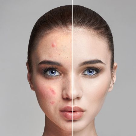 Picture for category Acne treatment